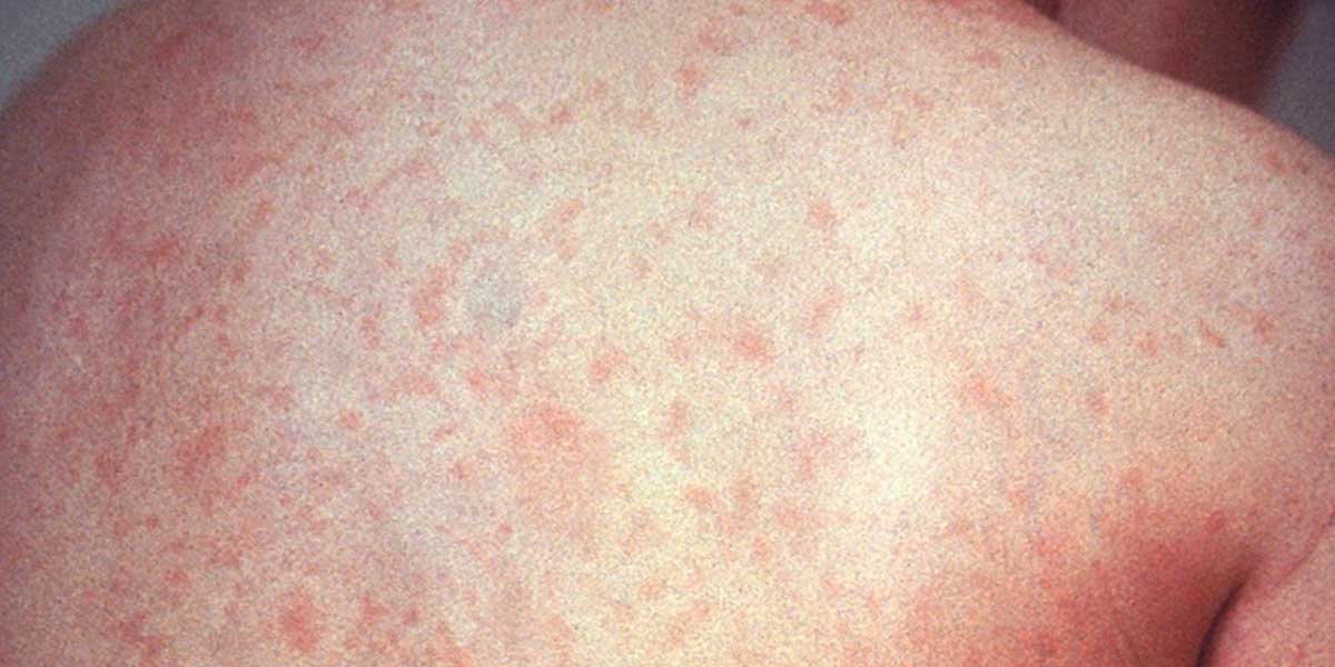 Measles Cases Surge Worldwide,  Infecting 10.3 Million People In 2023