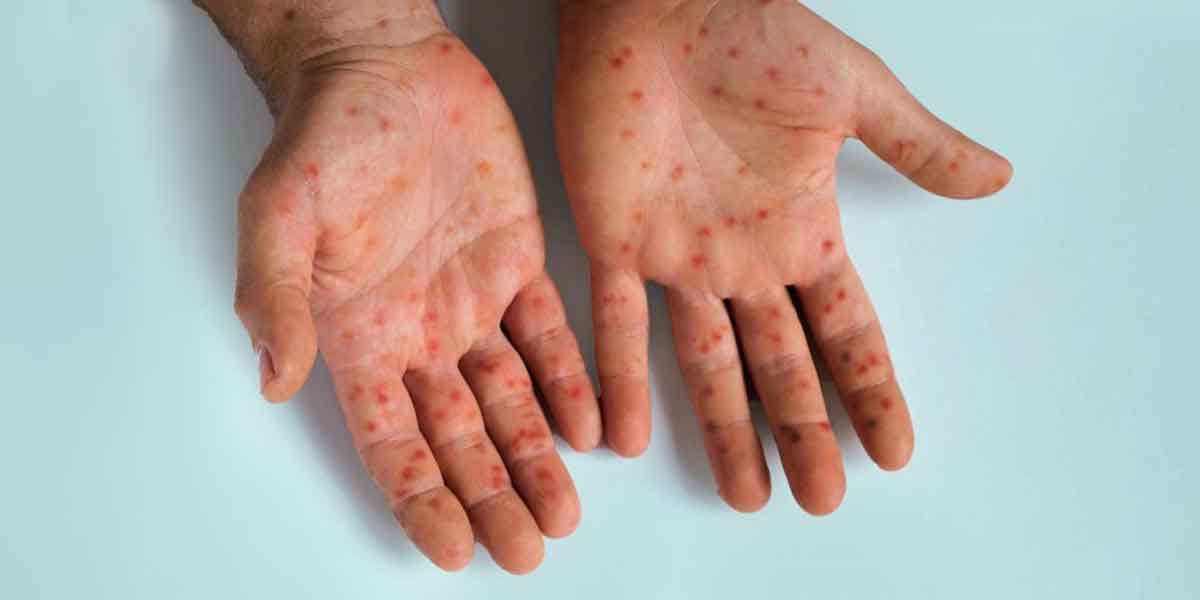 WHO Issues New Mpox Care and Safety Guidelines